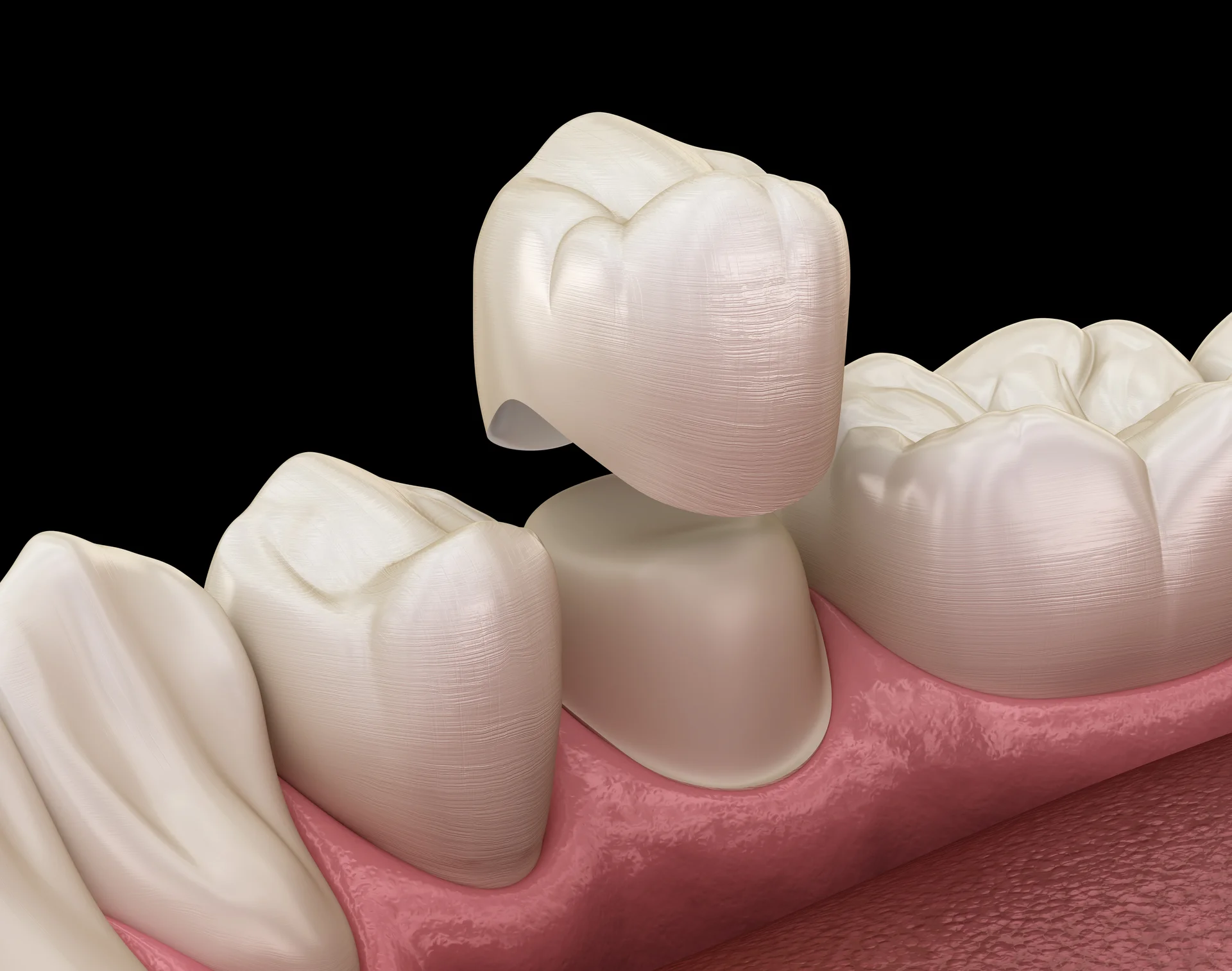 Same-day crown care at Anamosa Dental Associates