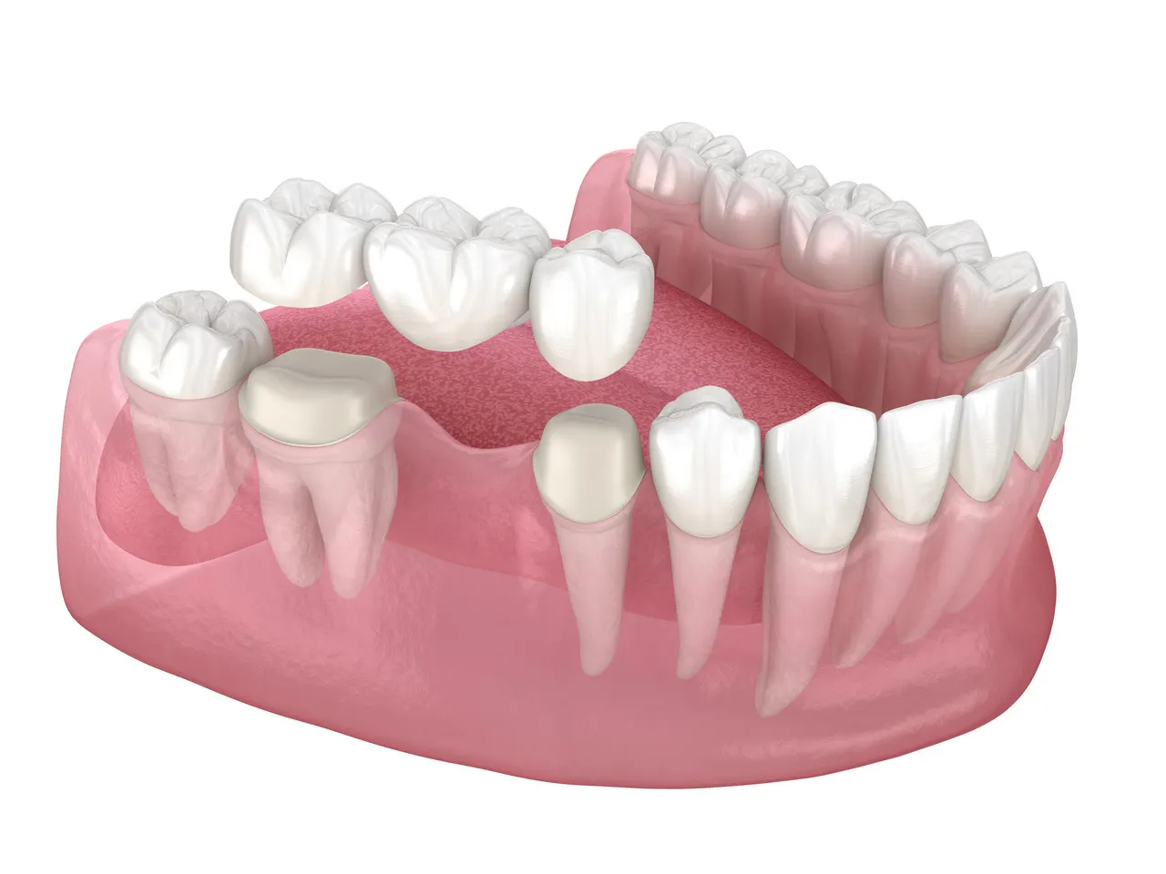 An illustration of a dental bridge spanning a gap in the lower arch