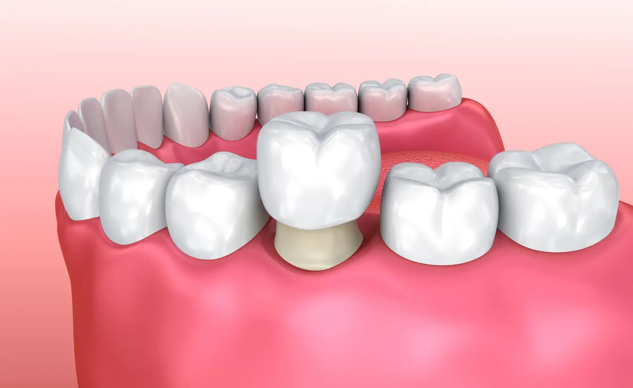 An illustration of a crown seated over a prepared molar