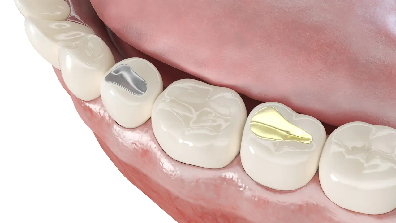 A close-up view of filled molars