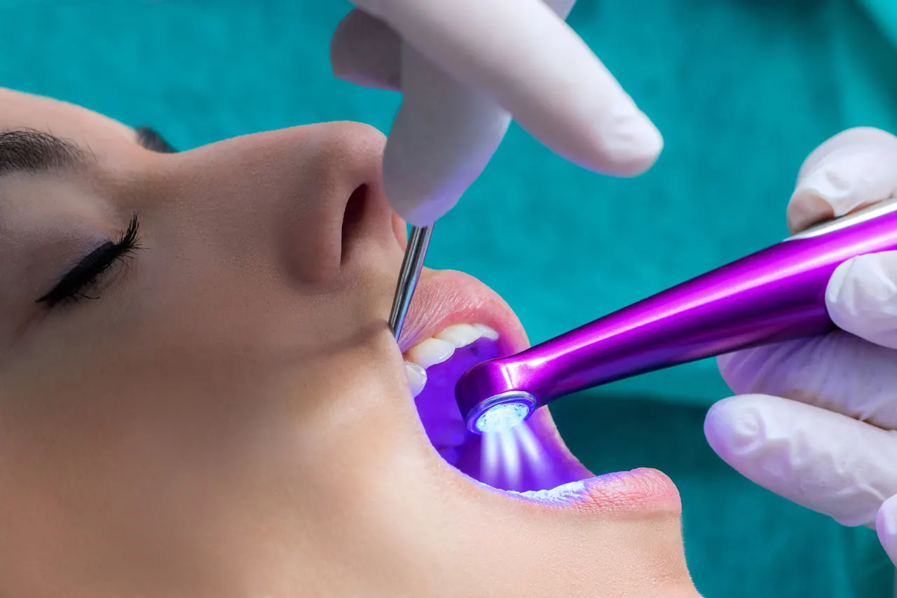 A sealant being cured on a patient's tooth