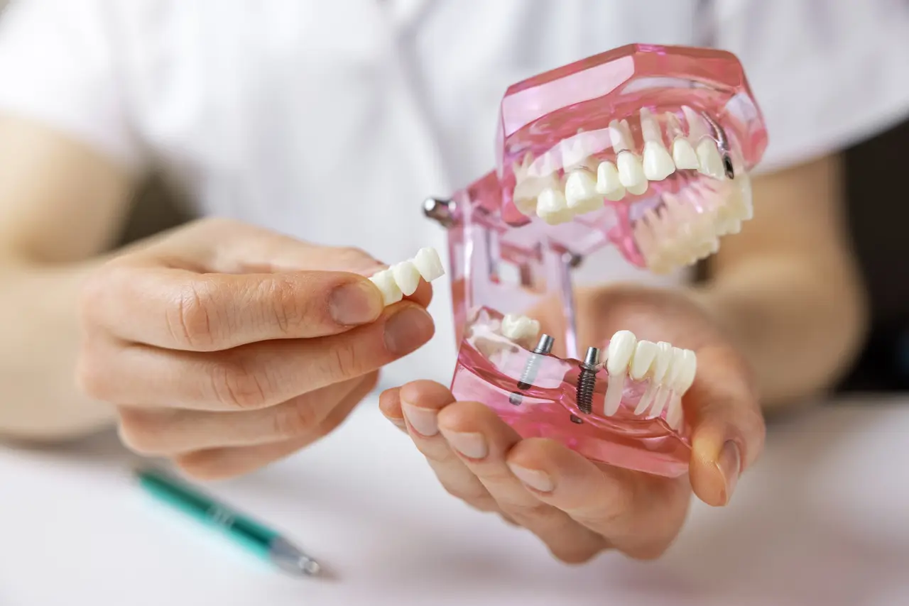 A dentist demonstrating an implant-supported bridge on a model