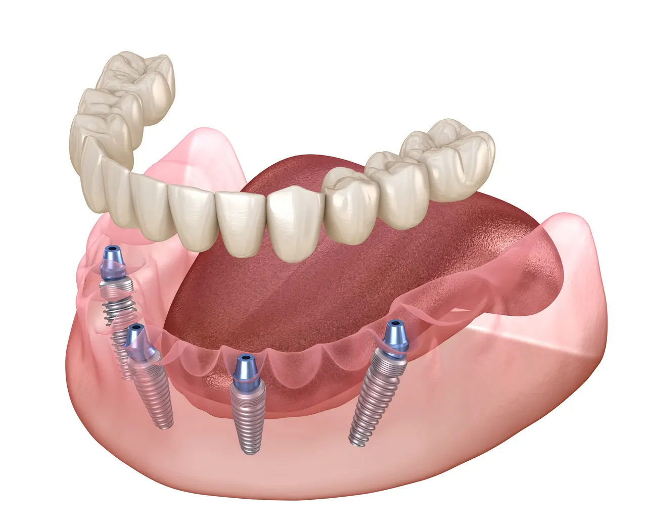 An illustration of a denture anchored on dental implants