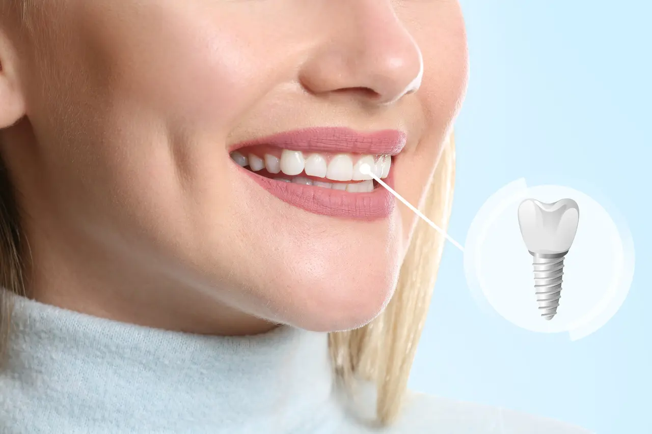 A smile beside an illustration of a single dental implant